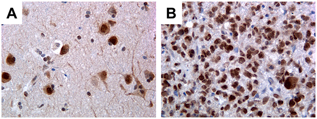 Immunohistochemical detection of PATZ1 in human GBM and perilesional normal cortex.