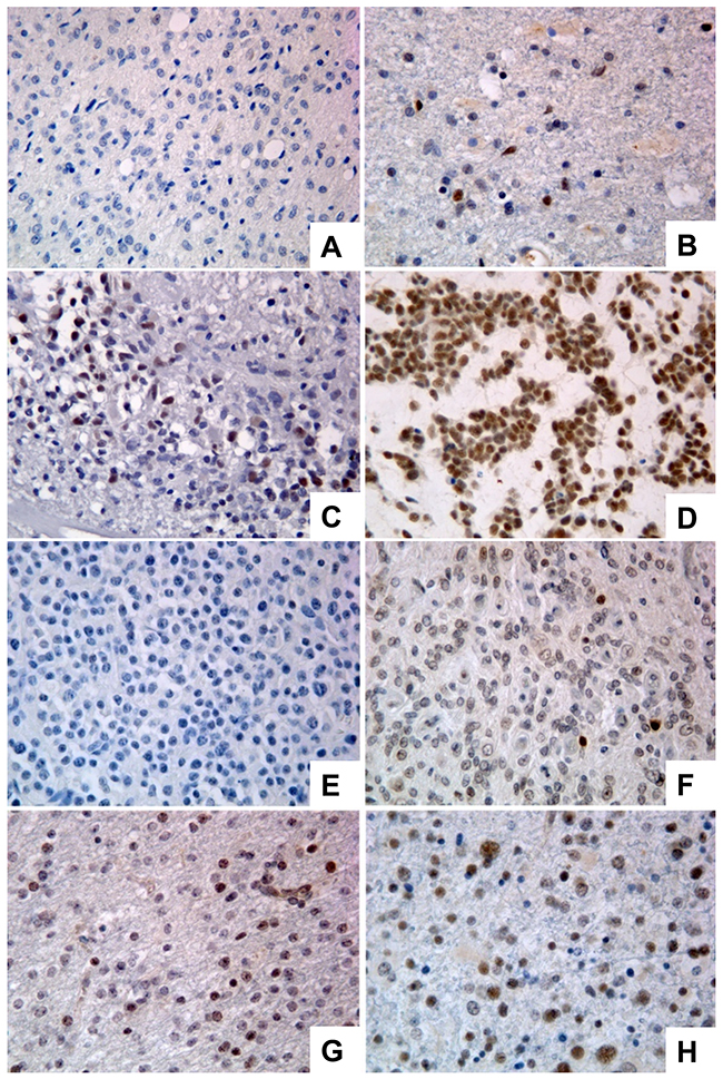 Immunoreactivity score in GBMs and oligodendrogliomas stained for PATZ1.