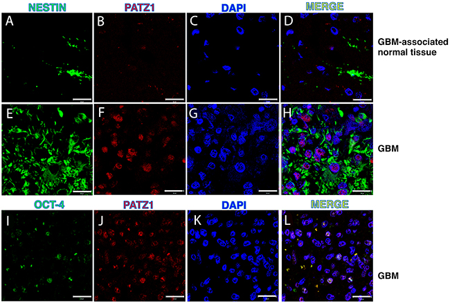 PATZ1 localization in the stem cell compartment of GBM.