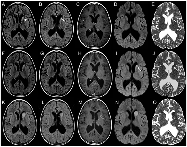 Brain MRI findings in an 8-year-old boy with focal distant medulloblastoma relapse detected earlier by DWI.