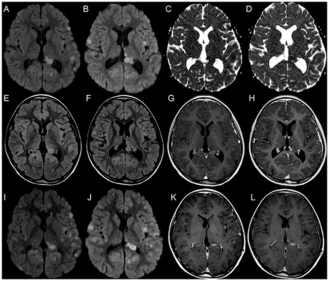 Brain MRI findings in a 12-year-old girl with multiple focal distant medulloblastoma relapsing lesions better depicted by DWI.