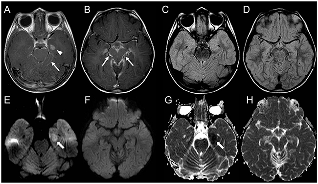 Brain MRI findings in a 7-year-old girl with AT/RT relapse and linear leptomeningeal involvement not visible on DWI.