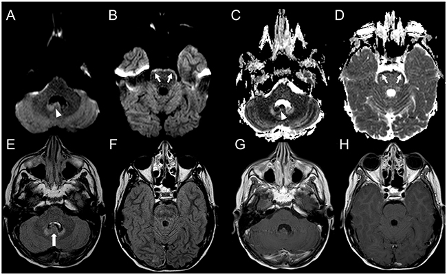 Brain MRI findings in a 12-year-old boy with CNS ET, NOS relapse and linear leptomeningeal involvement visible only on DWI.