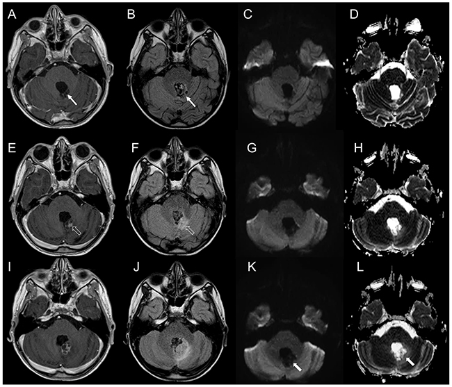 Brain MRI findings in a patient with non-neoplastic radiation induced focal lesion.