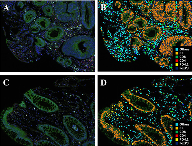 Representative multiplex IF images of pretreatment rectal cancer biopsy tissue.