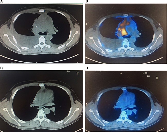 Baseline and interim PET-CT scans for a patient of T-LBL.