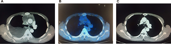 Imaging scans through the whole treatment for a patient of T-LBL.