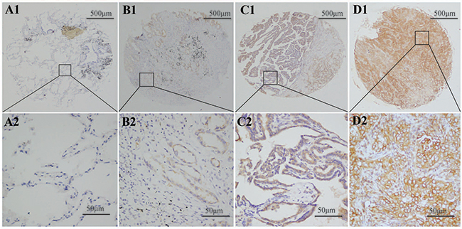 SPON2 protein was detected in pulmonary ADCs tissues and normal lung tissues.
