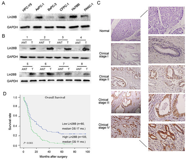 Lin28B expression is upregulated in PDAC cell lines and primary human PDAC tissues.