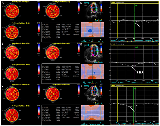 Bulls eye diagrams of the peak systolic strain of LV in the subendocardial, midmyocardial, and subepicardial layers at three time points (A, B, C).