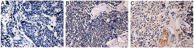 Immunohistochemistry staining of osteopontin (OPN) in lung cancer tissues (&#x00D7;400 magnification).