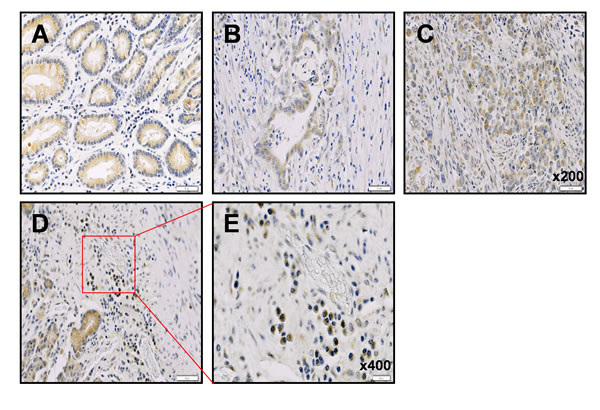 Immunohistochemical analysis of neogenin-1 expression in human gastric cancer patient tissues.