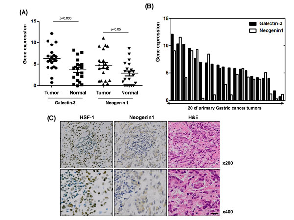 Positive association between galectin-3 and neogenin-1 expression, and HSF-1 and neogein1 expression in malignant and normal tissues from gastric cancer patients (A) mRNA expression levels of galectin-3 and neogenin-1 from malignant tissues of 20 gastric cancer patients are presented in a histogram.