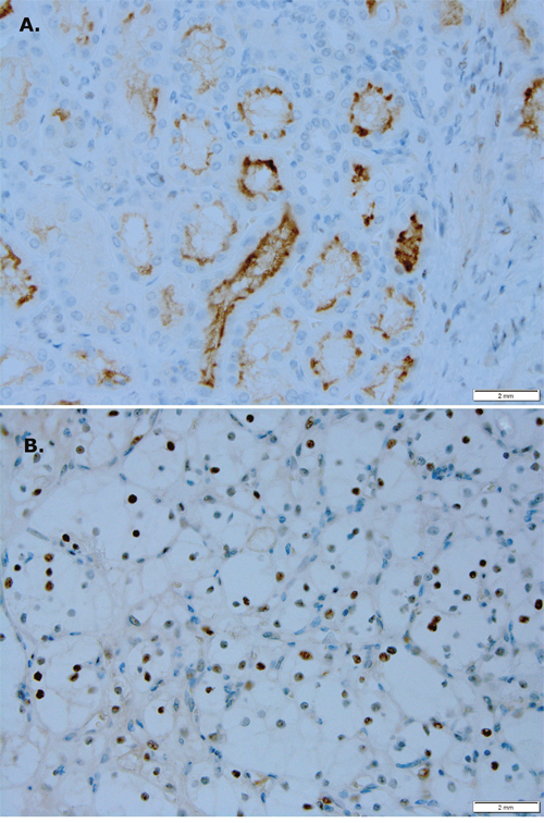 PIM1 kinase expression is different in RCC versus normal renal tissue.