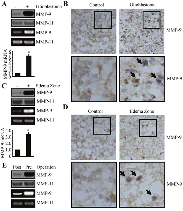 MMP-9 expression is increased in human GBM tissues and edema zones, relative to normal controls.