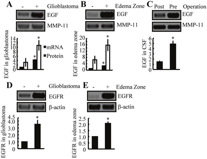 EGF and EGFR expression are increased in human GBM tissues and in the edema zone, relative to normal controls.