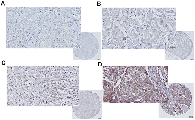 iNOS expression immunohistochemistry in TNBC.