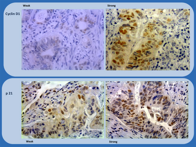 Immunohistochemistry study of biopsies (Cyclin D1 and p21) showing representative examples of weak and strong staining (x200 and x100).