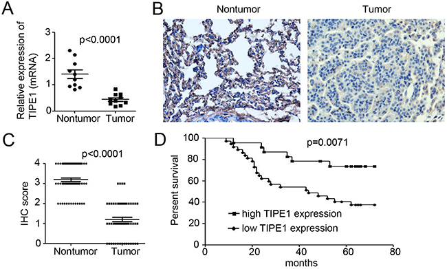 TIPE1 de&#xFB01;ciency promotes lung cancer progression and correlates with a worse patient prognosis.