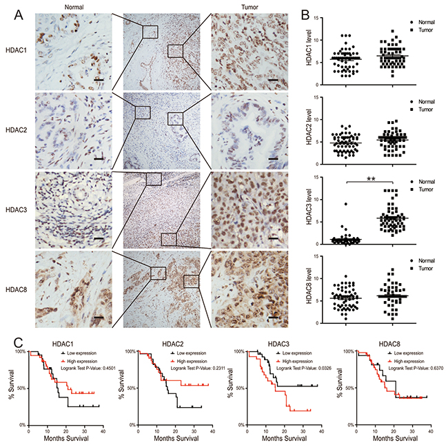 HDAC3 expression is increased in CCA tissues.