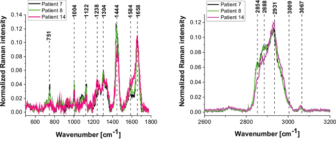 The average vibrational Raman spectra in the low and high frequency region for different areas of the low-grade brain tumor (astrocytoma, grade WHO I and II) (P7, P8, P14), Raman integration time for images 0.5 s for high frequency and 1s for low frequency region, resolution step: 1 &#x03BC;m, laser excitation power: 10m W.