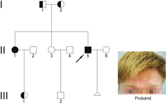Clinical features and family pedigree.
