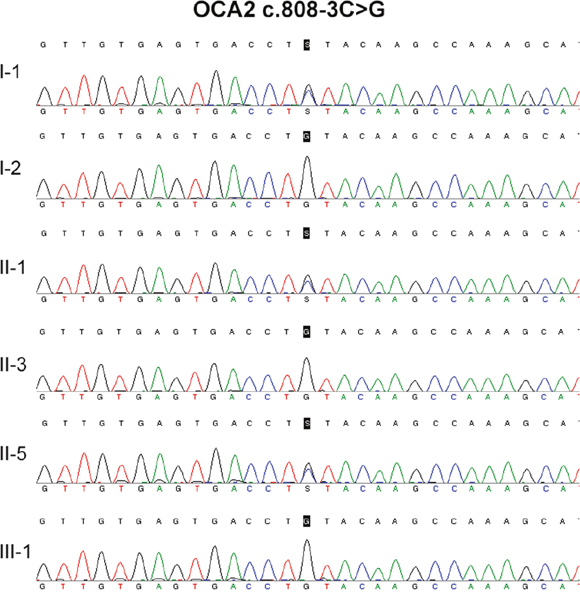 DNA sequencing result of OCA c.808-3C&#x003E;G.