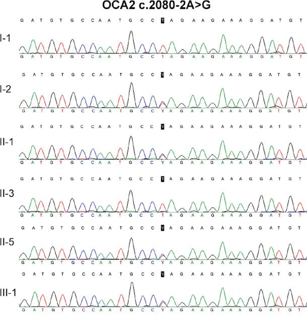 DNA sequencing result of OCA c.2080-2A&#x003E;G.