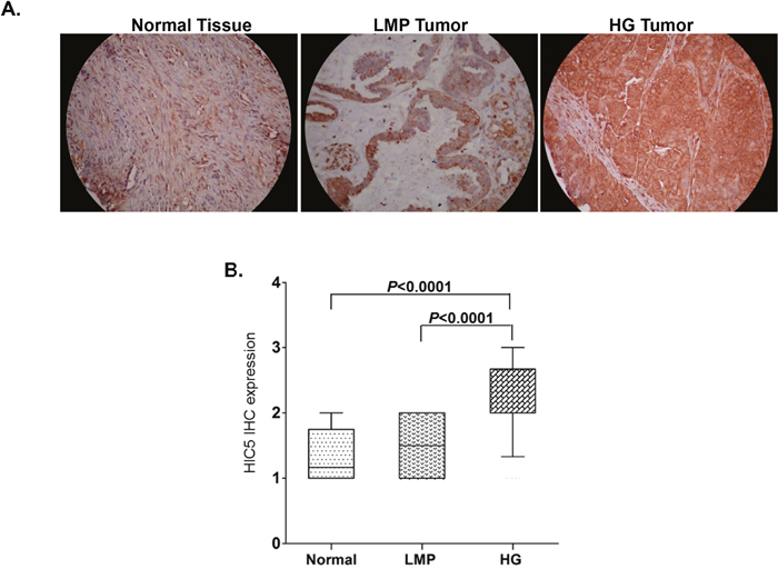 Analysis of Hic-5 expression in serous EOC tumors by IHC.