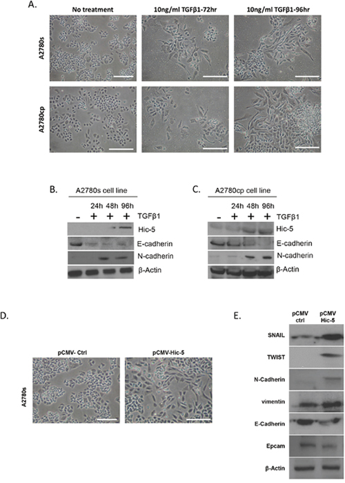 Effects of TGF&beta;1 treatment and Hic-5 ectopic expression on EMT modulation in EOC cells with epithelial phenotype.