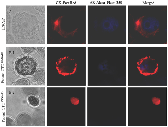 Image gallery after isolation, cytomorphological analysis and detection of cytokeratin-positive cells (CK+, red staining) and androgen receptor expression (AR, blue staining).