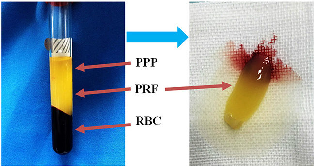 Isolation of PRF clots from venous whole blood via centrifugation.