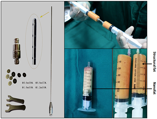 Lipoaspirate was mechanically emulsified after rinsing.