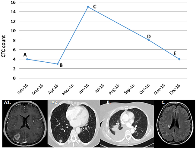 Correlation between CTCs and clinical course in patient 10.