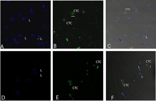 Cytomorphological differences between lymphocytes and CTCs.