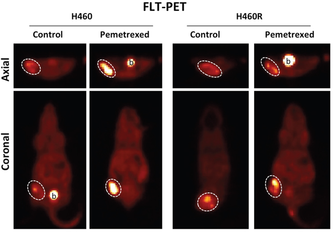 Pemetrexed-resistance conferred by TS overexpression results in loss of the pemetrexed-induced thymidine salvage pathway &#x201C;flare&#x201D; in NSCLC in vivo.