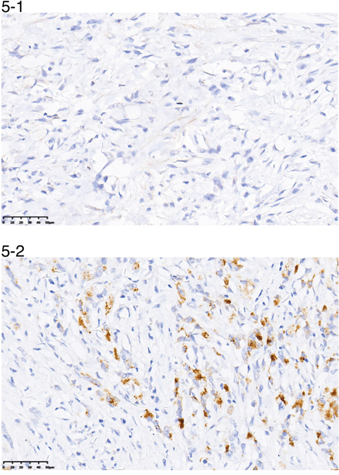 A representative image of negative (5-1) or positive (5-2) PR expression.