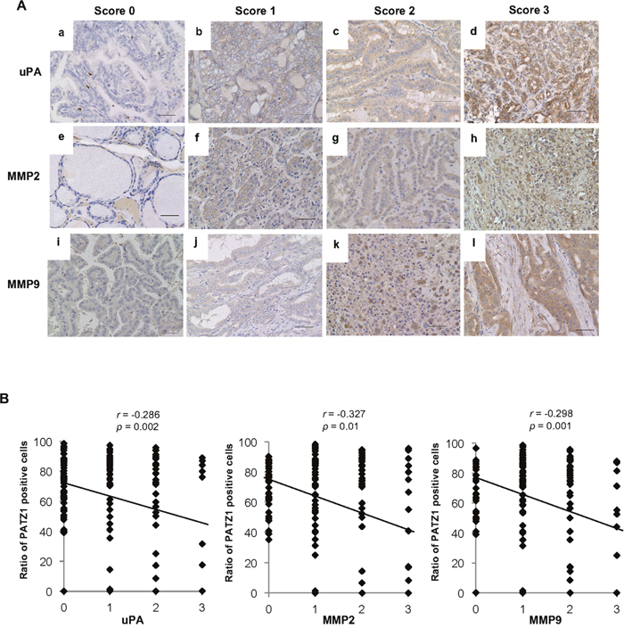uPA, MMP2, and MMP9 expression in the clinical thyroid tissues.