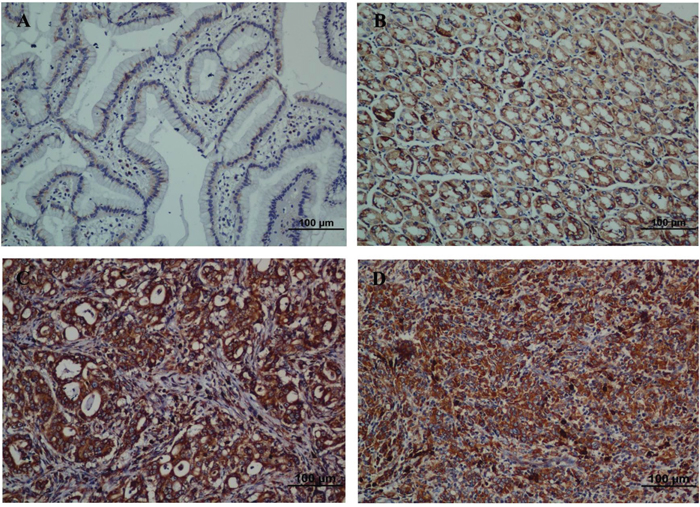 Strong expression of ENAH protein is observed in GC surgical specimens by immunohistochemistry.
