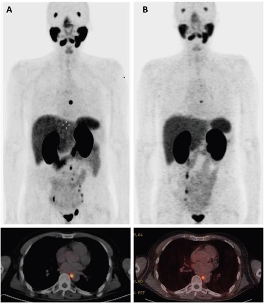 68Ga-PSMA-HBED-CC PET/CT before and after treatment with 177Lu-PSMA-617 RLT.