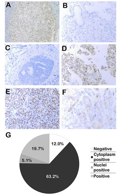 Immunohistochemical analysis of Eg5 expression in human clinical samples.