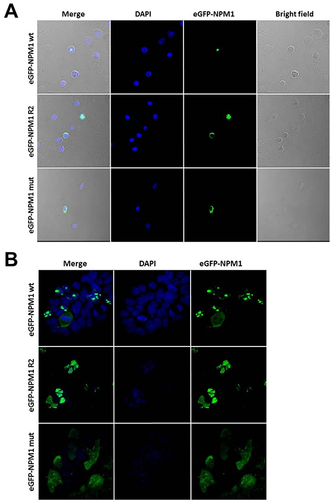 NPM1 wt, R2 and mut show different subcellular localization in AML patient and HEK293 cells.