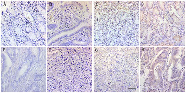 Immunohistochemical staining of NF1 in matched normal and gastric cancer tissues (Magnification: x200. Bar 200&#x03BC;m.)