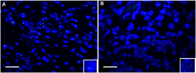 Shown was the amplification of PIK3CA in DLBCL tissue using fluorescent in situ hybridization (FISH).