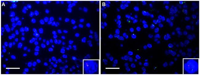 Shown was the deficiency of PTEN in DLBCL tissue using fluorescent in situ hybridization (FISH).