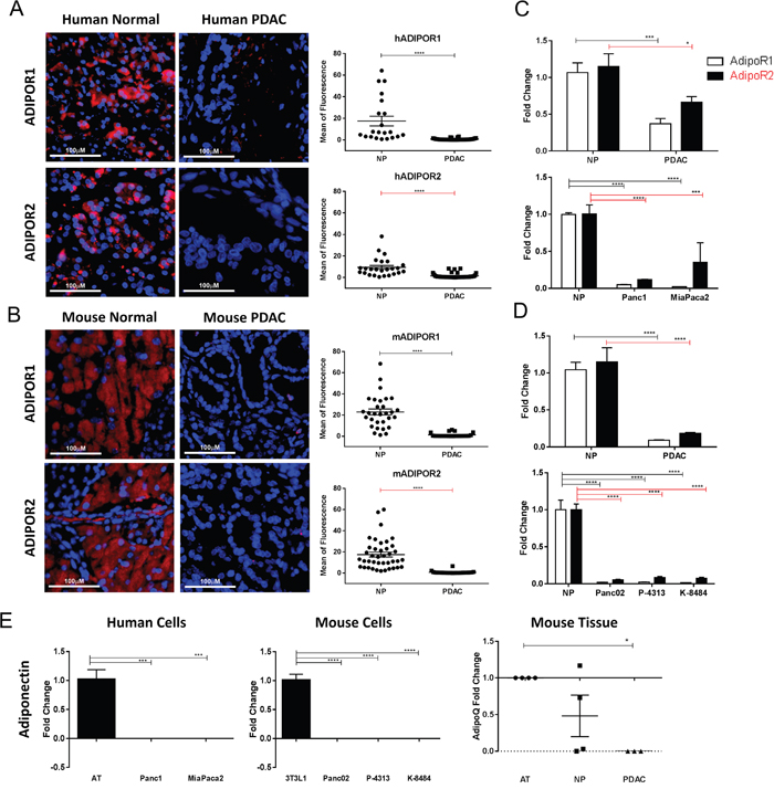 Adiponectin receptor levels are reduced in pancreatic cancer.