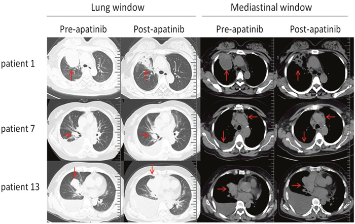 Representative CT images (lung windows and mediastinal windows) of three patients pre-apatinib and post-apatinib monotherapy.