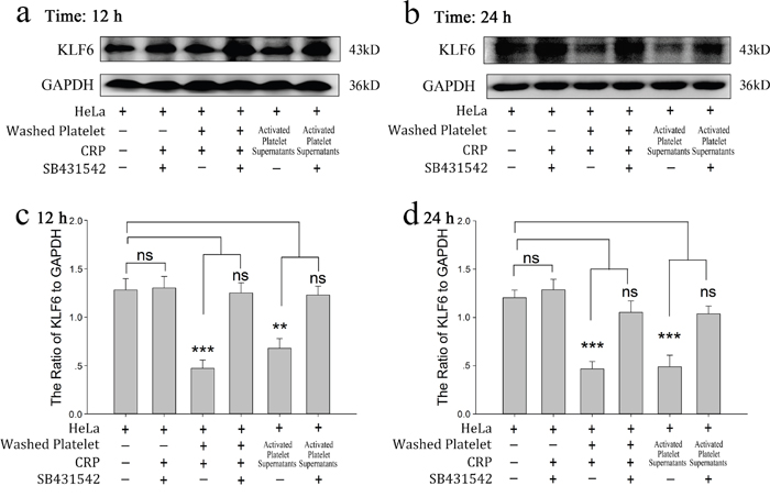 Platelet-derived TGF-&#x03B2; regulates the expression of KLF6 in cervical carcinoma cells.