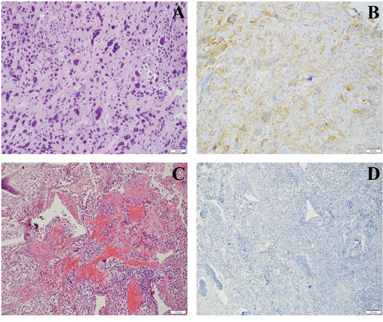 PD-L1 staining on TCs in metastatic sites.