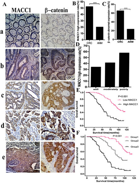 MACC1 and &#x3b2;-catenin expression in ANM (a) and CRC (b, well differentiated CRC; b, moderately differentiated CRC; d, poorly differentiated CRC; e, lymph node metastatic CRC) tissues by immunohistochemistry staining &times;200 (A); MACC1(B) and abnormal &#x3b2;-catenin (C) expression was significantly higher in CRC than that in ANM, respectively ***p&lt;0.001; high MACC1 expression increased with the decreased histological differentiation degree of CRC (D); Overall survival(OS)of CRC patients with different levels of MACC1 expression by Kaplan-Meier analysis (E); OS of CRC patients according to the combination of MACC1 and &#x3b2;-catenin expression levels.